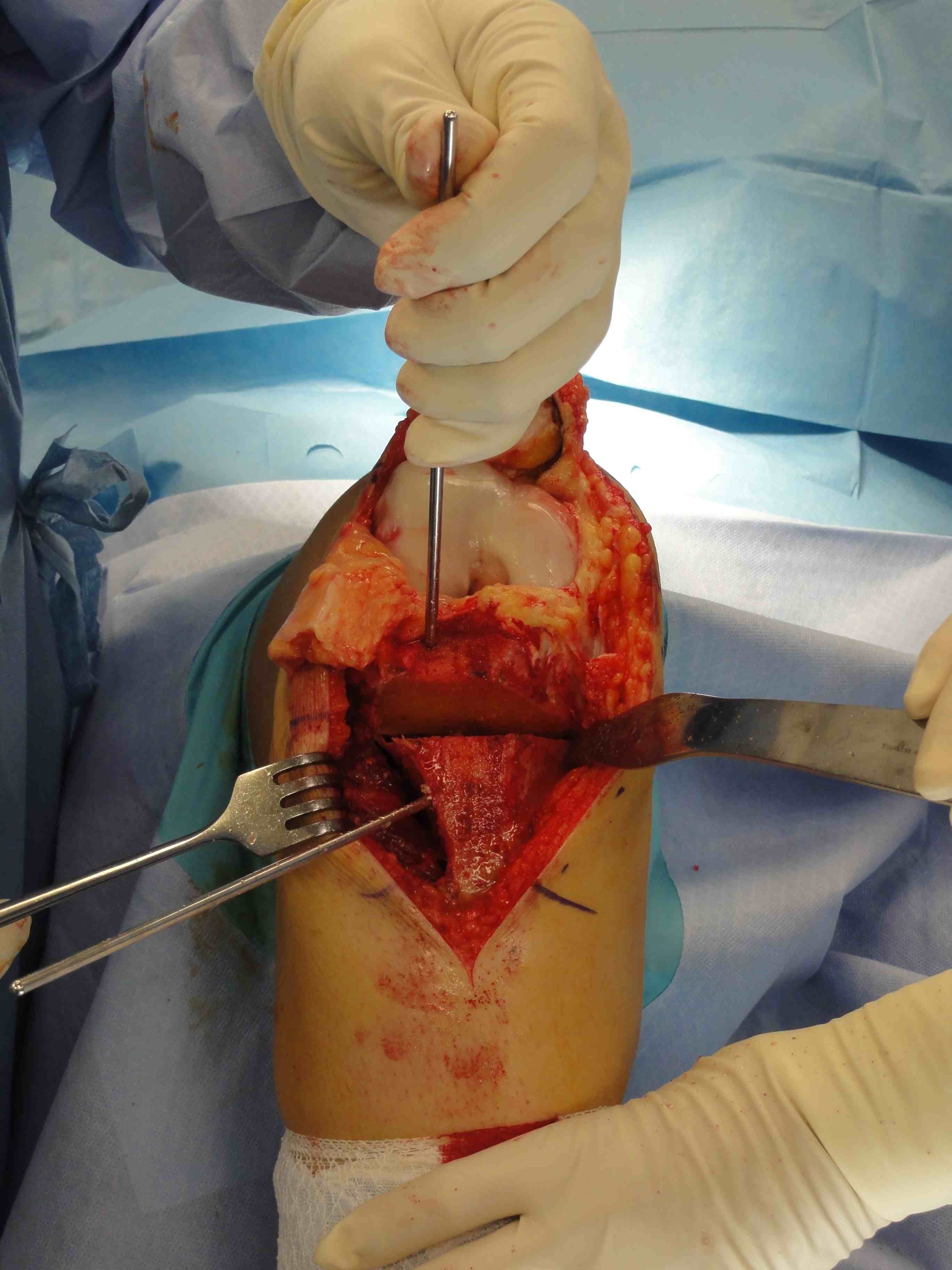 Tibial Derotation Osteotomy